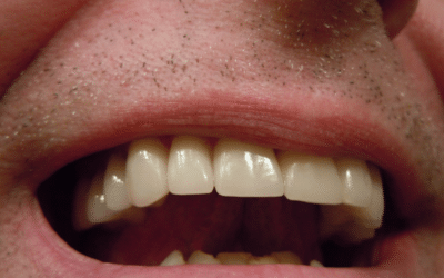 5 Tips que debes tener en cuenta para el cuidado de tus implantes dentales