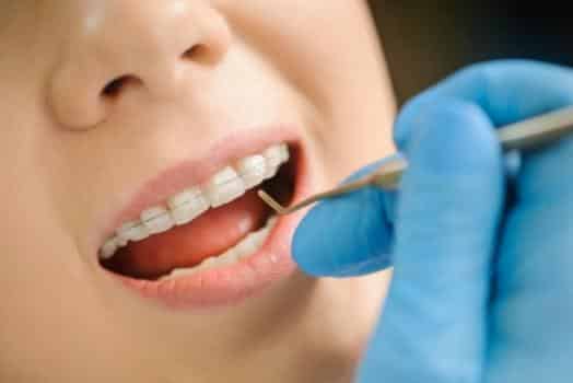 Imagen dentadura con ortodoncia invisible