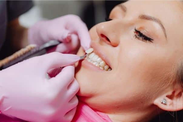 ¿Qué son las carillas dentales? Ventajas y desventajas