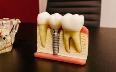 Coronas dentales: todo lo que debes saber sobre estas prótesis