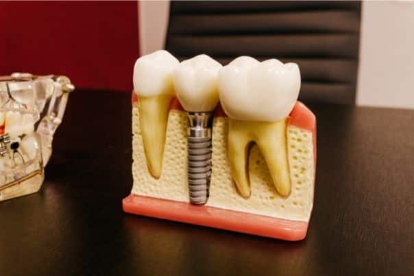 Coronas dentales: todo lo que debes saber sobre estas prótesis