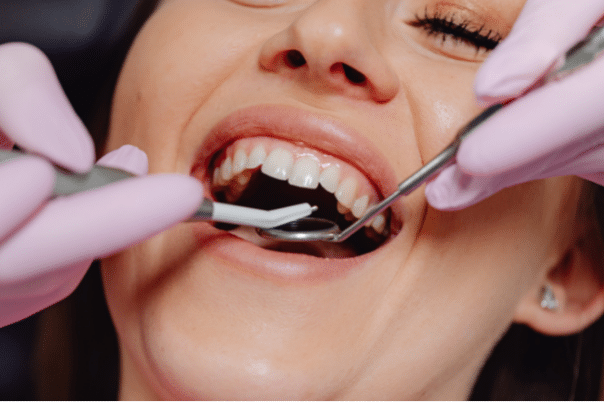 Cuida tus implantes dentales