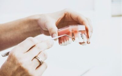 Tipos de implantes dentales: clasificación y cuidados