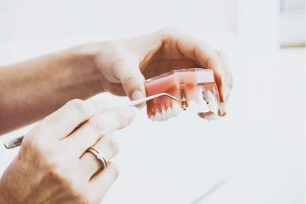 Tipos de implantes dentales: clasificación y cuidados