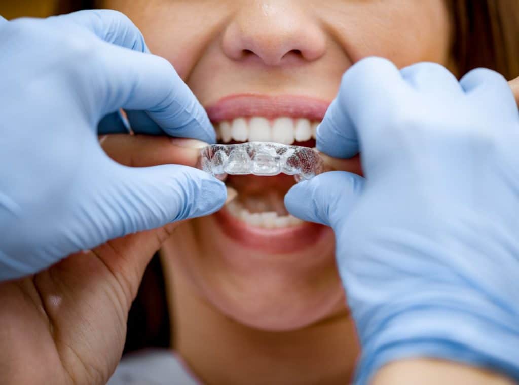 Colocando el tratamiento de ortodoncia invisible