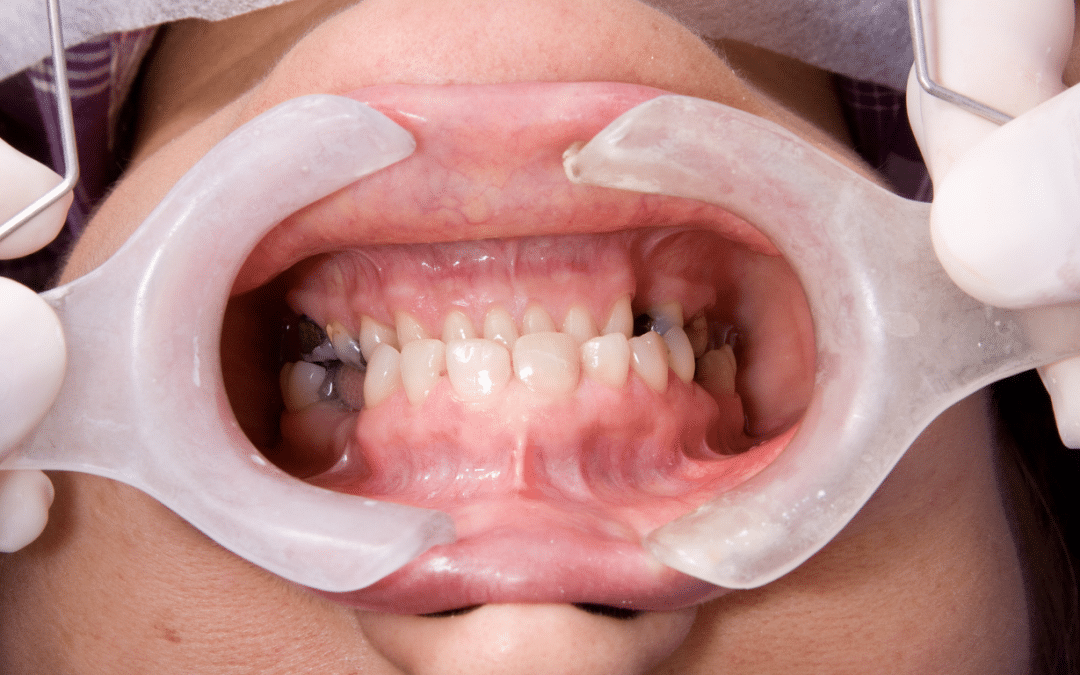 Rehabilitación oral: Restaura tu sonrisa y salud bucal en Colombia