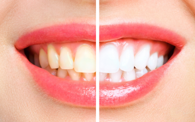 Blanqueamiento dental: ¿Qué es, cómo funciona y cuánto cuesta?