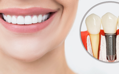 Implantes Dentales: La Solución Definitiva para Recuperar tu Sonrisa