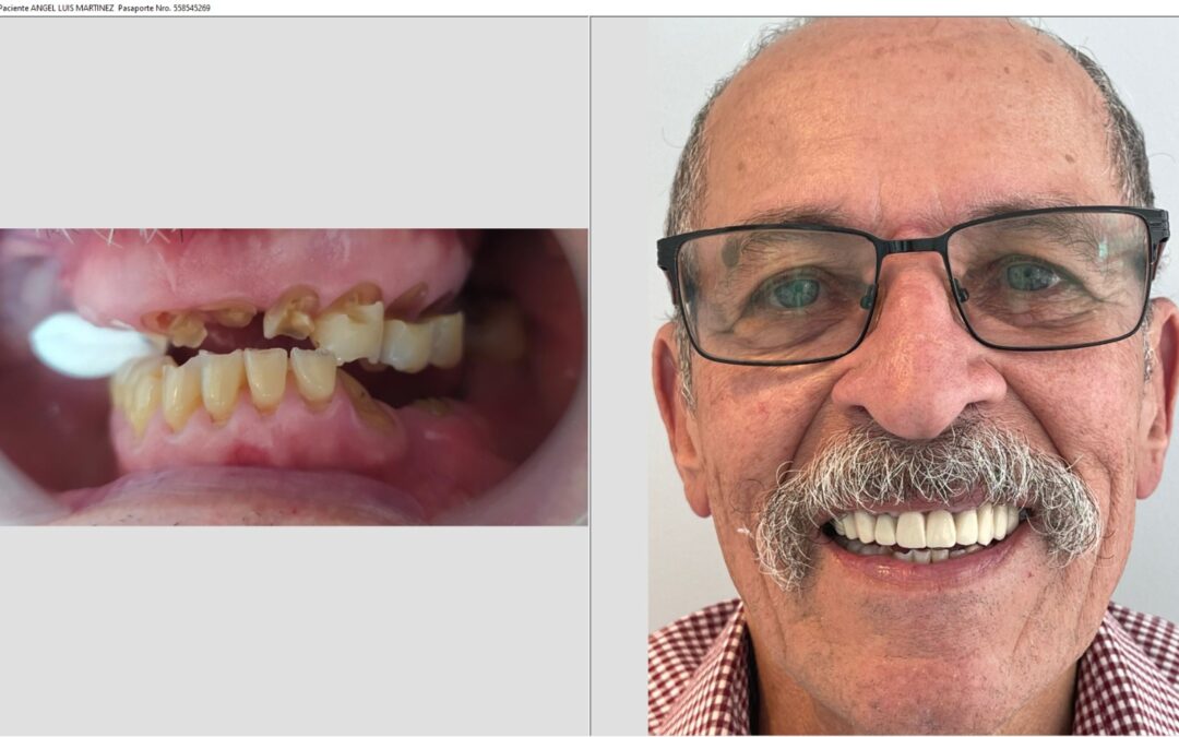 De Nueva York a Bogotá: La Transformación Dental de Ángel con Implant Bridge