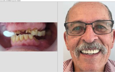 De Nueva York a Bogotá: La Transformación Dental de Ángel con Implant Bridge