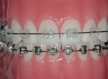 Brackets-de-zafiro-ventajas Diseño de sonrisa