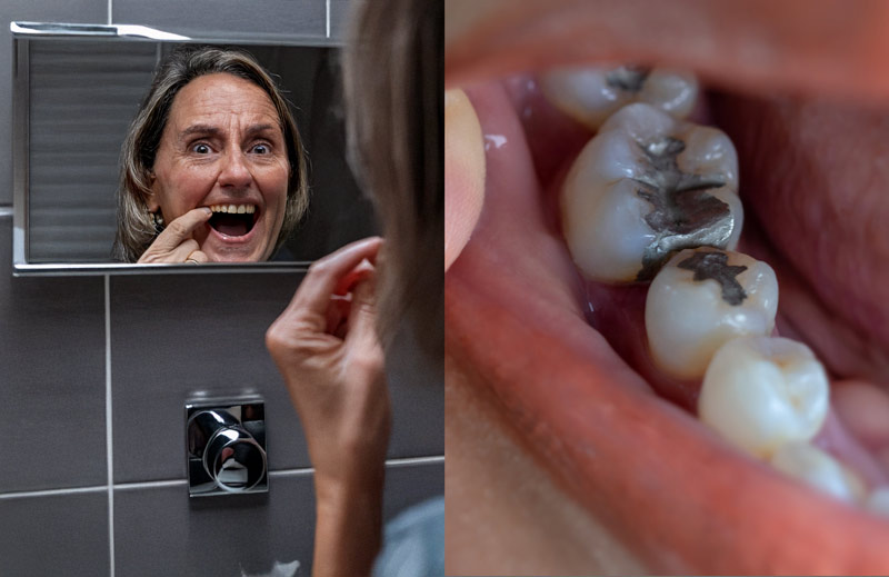 Los peligros ocultos de las amalgamas dentales: el caso de Rosa, una paciente desde EE. UU.